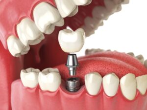 Dental Implant Consultation