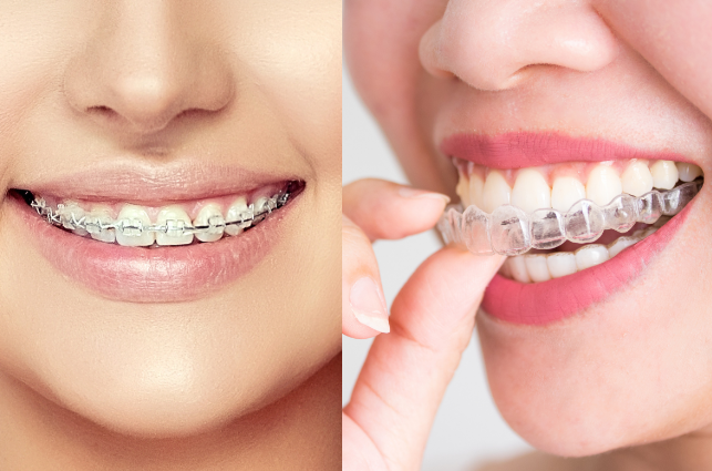 Invisalign vs. Traditional Braces: What's the Difference?