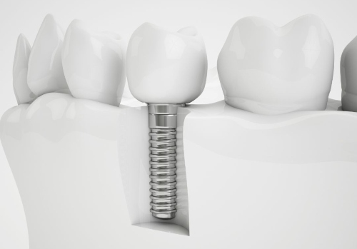 Dental implants for oral health in Ashburn VA