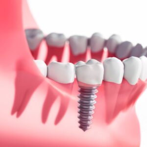 Recovering from Dental Implants
