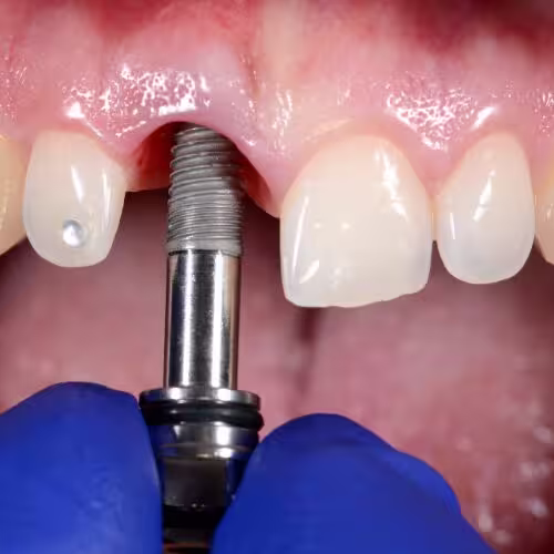 tooth preservation treatment