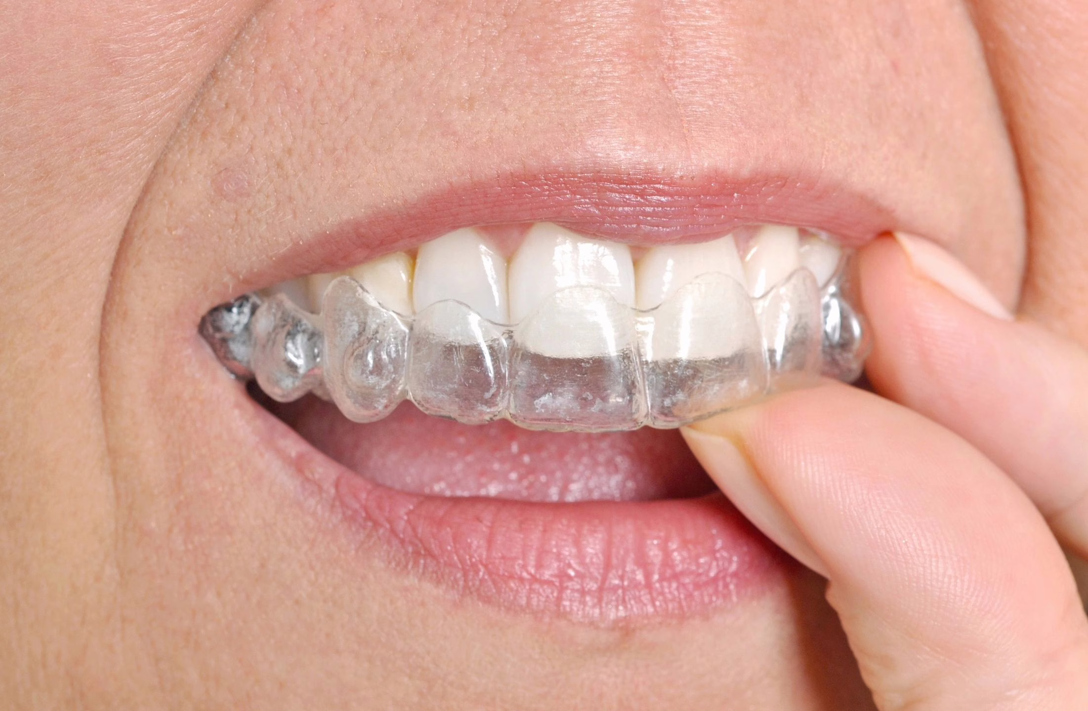 invisalign clear aligners lansdowne